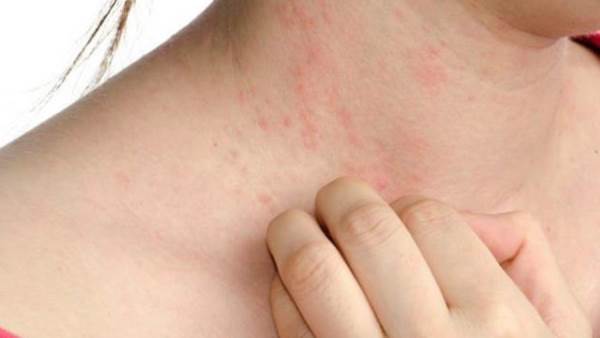 حساسية الخل