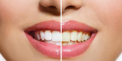  اصفرار الأسنان: الأسباب ووصفة سحرية لعلاجه