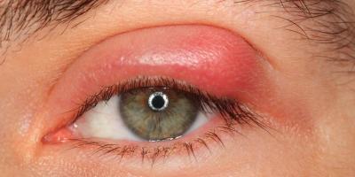 نصائح لعلاج التهاب الجفون بشكل طبيعي دون أدوية