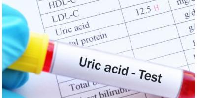 طرق بسيطة وفعالة لعلاج ارتفاع مستويات حمض اليوريك