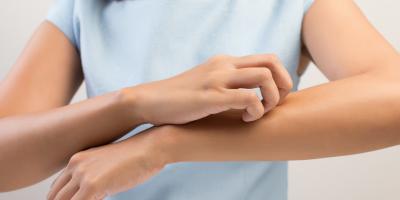 5 طرق طبيعية للتخلّص من حكة لدغة البعوض