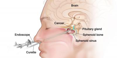 أعراض خطيرة لـ الغدة النخامية 