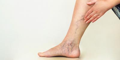 علاجات منزلية تخلصك من دوالي الساقين