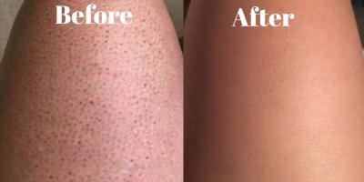 ما هي حالة رجل الفراولة الجلدية وكيف يمكن القضاء عليها؟