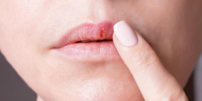 علاجات منزلية للتخلص من مشاكل التهابات الشفاه 