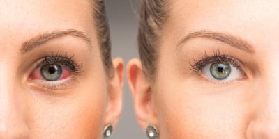 التهاب قزحية العين