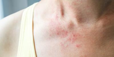 الطفح الجلدي التوتري .. ما هو وكيفية التعامل معه؟