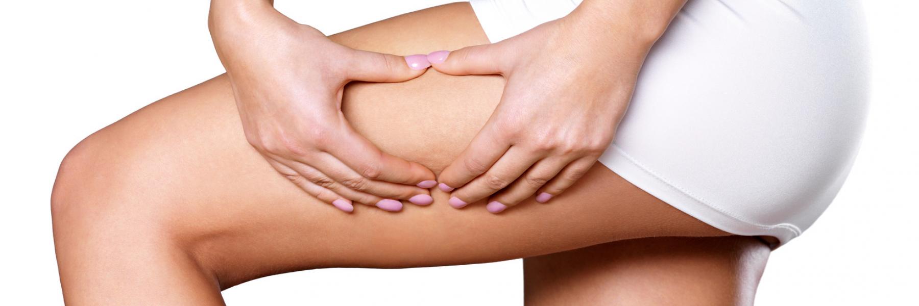 3 علاجات منزلية فعالة للتخلص من "السترتش ماركس".. تعرفي عليها