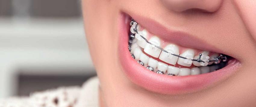 تقويم الأسنان