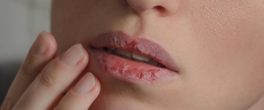 تشقق الشفاه