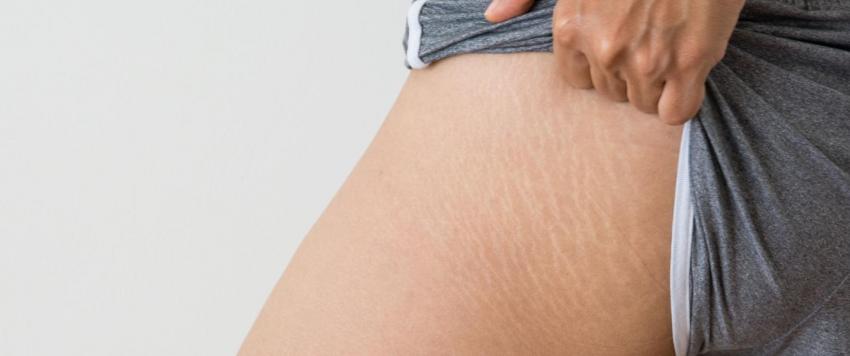 لماذا يجب أن نحب علامات التمدد في أجسامنا؟