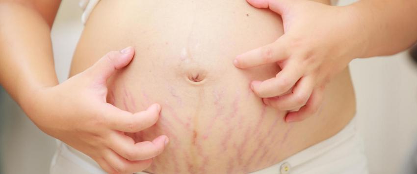 الكلف في الحمل