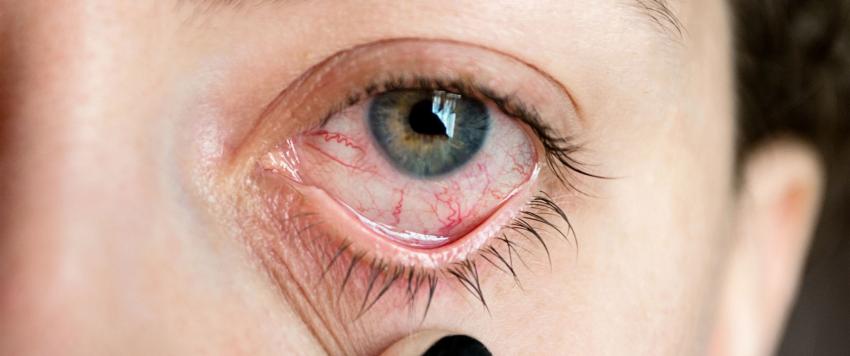 احمرار العيون