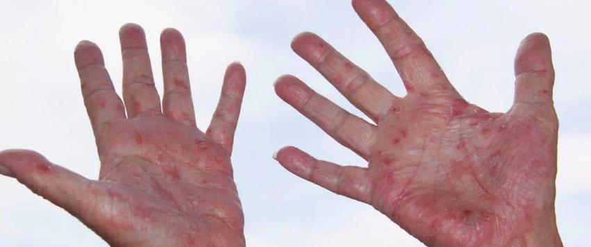 هل الاكزيما علامة على ضعف جهاز المناعة؟