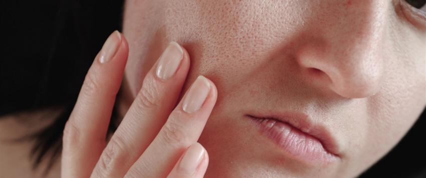 المسام الواسعة أمر مزعج.. إليكِ 5 طرق طبيعة للتخلص منها نهائياً