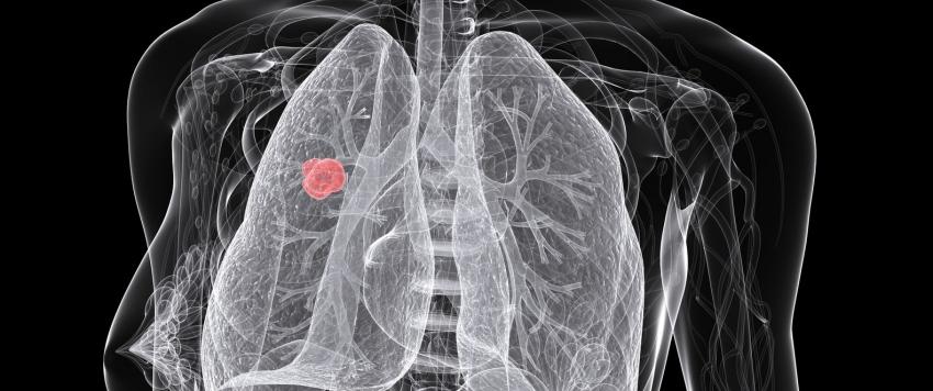 خرافات ومعلومات زائفة عن سرطان الرئة