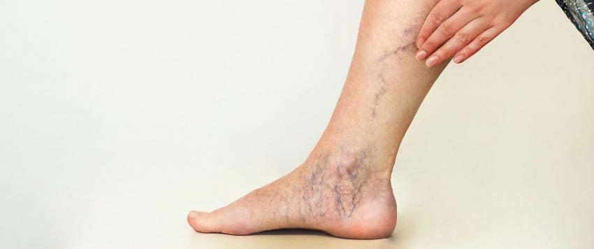 دوالي الساقين