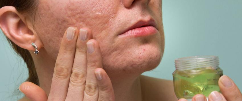 علاجات طبيعية لإزالة ندوب وجروح الوجه