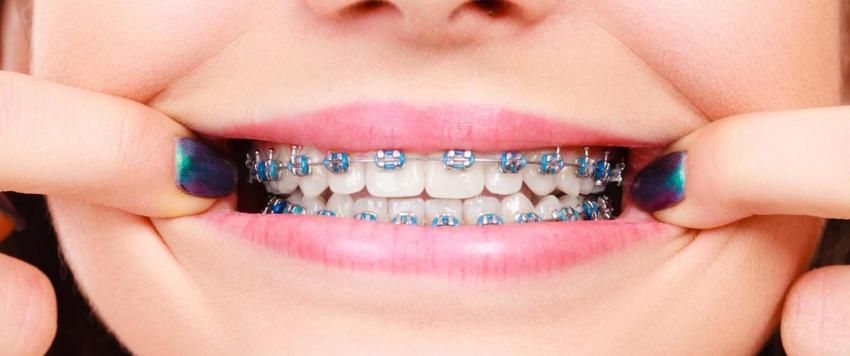 أفضل الطرق للحفاظ على بياض الأسنان أثناء ارتداء التقويم
