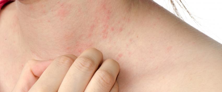 هل يمكن أن يعالج استخدام المرطب أعراض الأكزيما؟