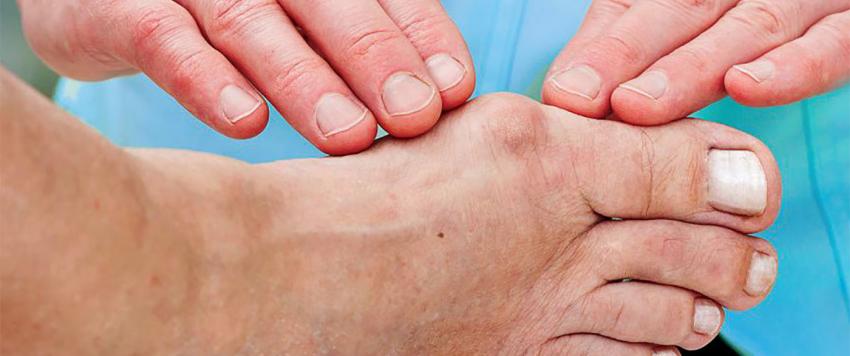 البروز العظمي