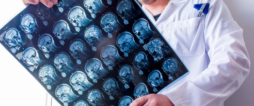 التصلّب اللويحي