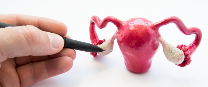 تكيس المبايض